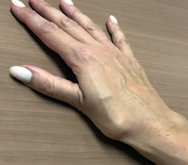 arthritis